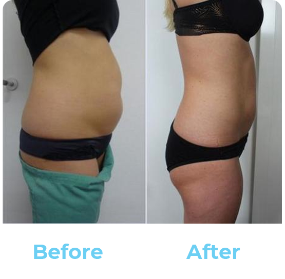 Cryotherapy Results